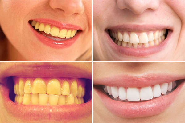 “Bí mật” giúp răng trắng bóng không cần phải tới nha sỹ