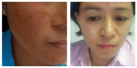 NGUYÊN NHÂN NÁM DA VÀ CÁCH PHÒNG, ĐIỀU TRỊ THEO LIỆU TRÌNH “BÁC SĨ”