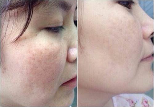 Chà 1 lát cà tím lên mặt, kết quả sau 1 tuần khiến ai cũng hốt hoảng