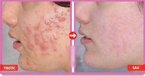 Trị mụn mủ, mụn bọc tại nhà chỉ ngay sau 1 đêm
