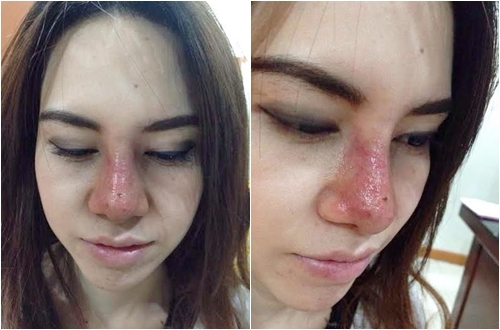 Cánh báo: nếu nặn mụn ở vùng này, bạn sẽ có nguy cơ bị tử vong