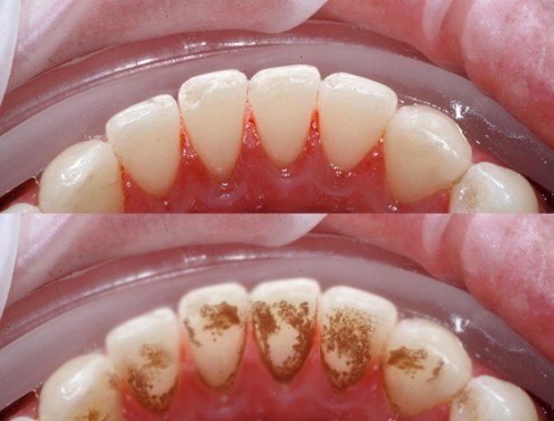 Trước khi đi ngủ, ngậm thứ nước này 1 phút, cao răng sẽ bong ra từng mảng