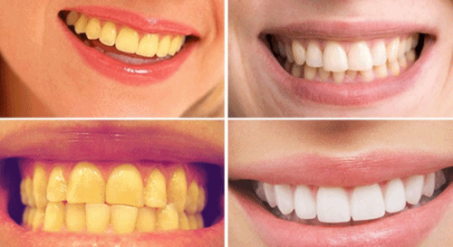Bí quyết tẩy răng xỉn màu, ố vàng trong tích tắc với 2 cách làm đơn giản không tốn 1 xu