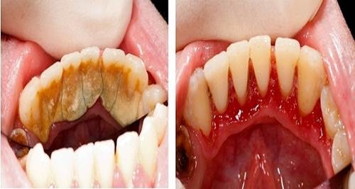 2 cách tẩy sạch mảng bám kinh niên lẫn vết ố răng dai dẳng trong tích tắc chỉ cần nước cốt chanh