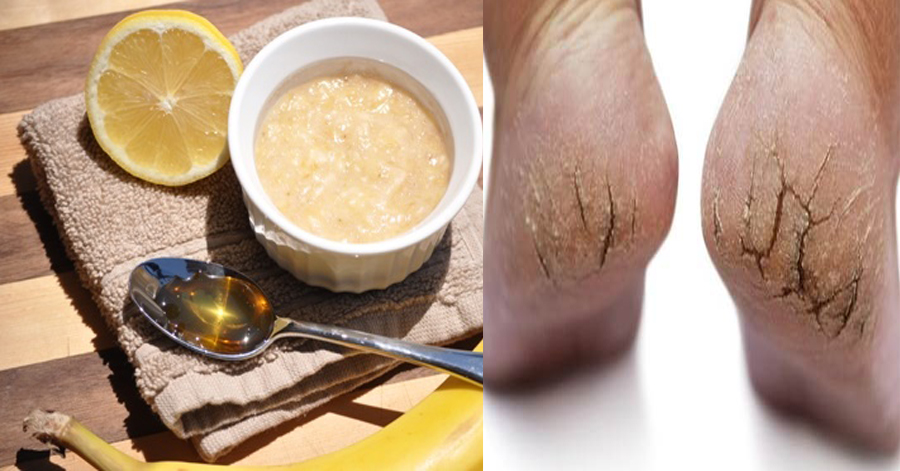 Trị khỏi nứt gót chân, chai sần lâu năm nhờ 1 quả chuối, cách hay nên thử