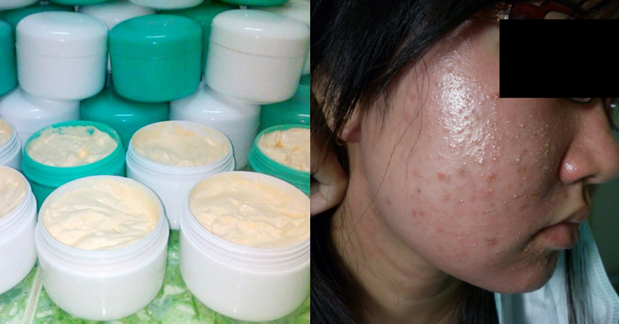 Những hậu quả kinh hoàng này chắc chắn sẽ khiến 100% phụ nữ không bao giờ dám dùng kem trộn nữa