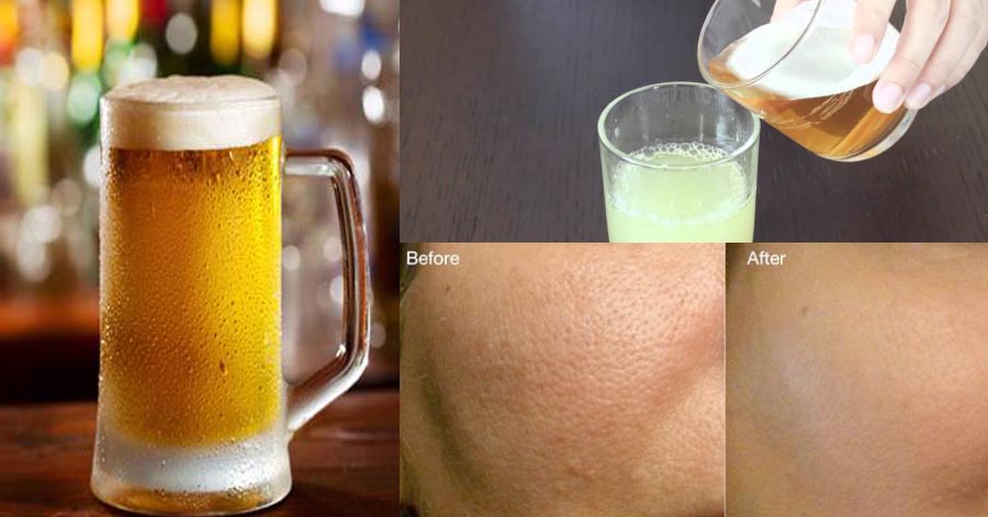 Bất ngờ se khít lỗ chân lông ngay tại nhà chỉ nhờ 1 cốc bia