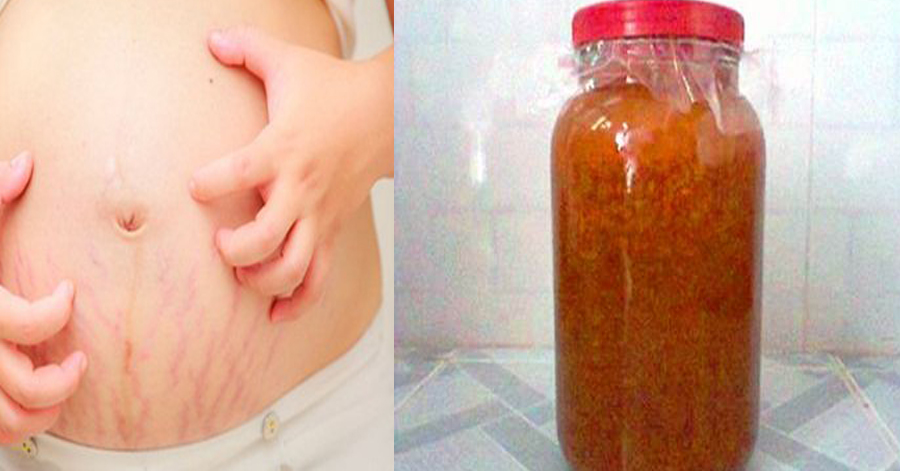 Kỳ tích đánh bay cả rổ mỡ thừa siêu hiệu quả, nghe xong là giật mình vì quá khó tin