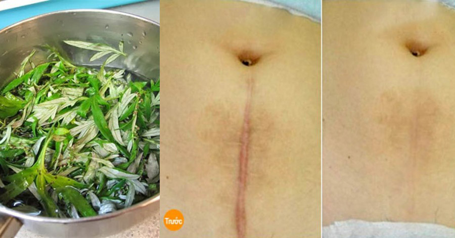 Sẹo lồi sẽ mờ đi 80% chỉ sau 3 tuần nhờ 1 nắm lá ngải cứu tươi