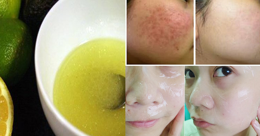 Độc chiêu trị mụn thâm, nám, tàn nhang trong 8 tiếng chỉ nhờ 1 quả chanh