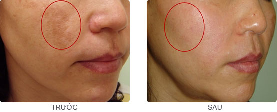 Nám da ngày càng nặng do sai phương pháp điều trị