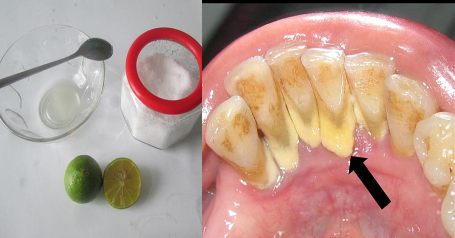 Ngậm nước chanh muối trong 5 phút, mảng bám ố vàng trên răng biến mất ngay