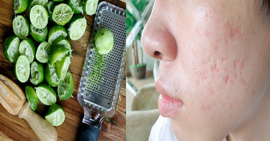 Vắt chanh đừng dại bỏ vỏ – đây là ‘’thần dược’’ cho nhan sắc nhà nào cũng có