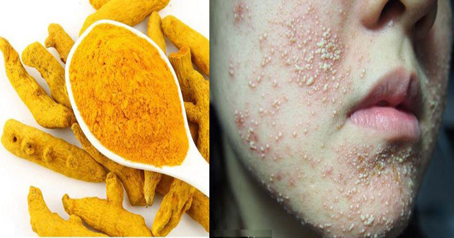 Cứ tưởng nghệ là thần dược nhưng dùng không đúng cách thì da đẹp đến đâu cũng dễ mụn nhọt, lở loét chẳng khác nào bôi hóa chất
