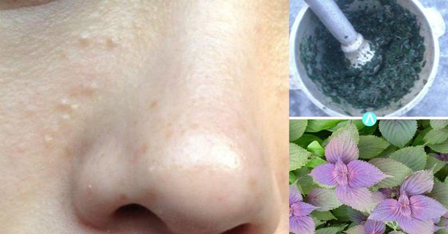 Da trắng mịn căng mướt, sạch mụn đơn giản với lá tía tô