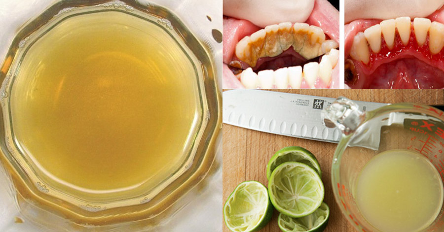 Ngậm thứ nước này trong 2 phút, cao răng bật ra từng mảng, răng ố vàng cũng trở nên trắng sáng