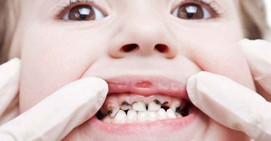 Nước lá chanh đun đặc: Phương pháp trị sâu răng, viêm lợi thậm chí là hôi miệng vô cùng hiệu quả