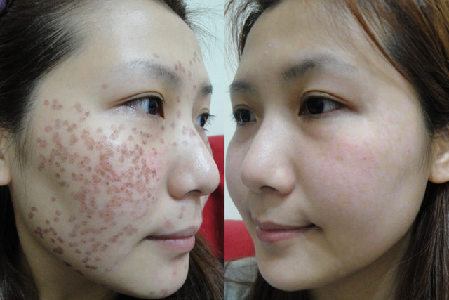 “Đánh bật” nám, lấy lại tuổi thanh xuân, tươi trẻ của làn da ngay tại nhà