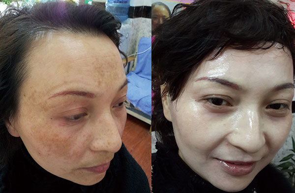 “Vực dậy” làn da không tuổi cho những chị em bị nám, tàn nhang