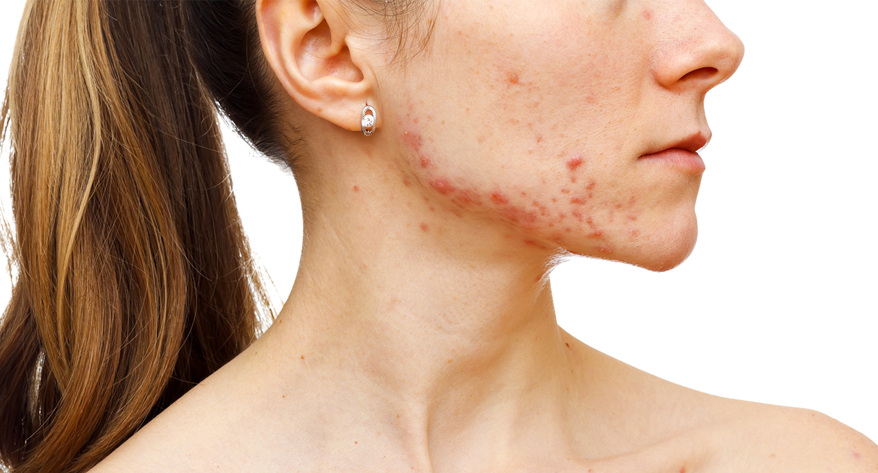 Phân biệt vết thâm mụn và các loại sẹo mụn