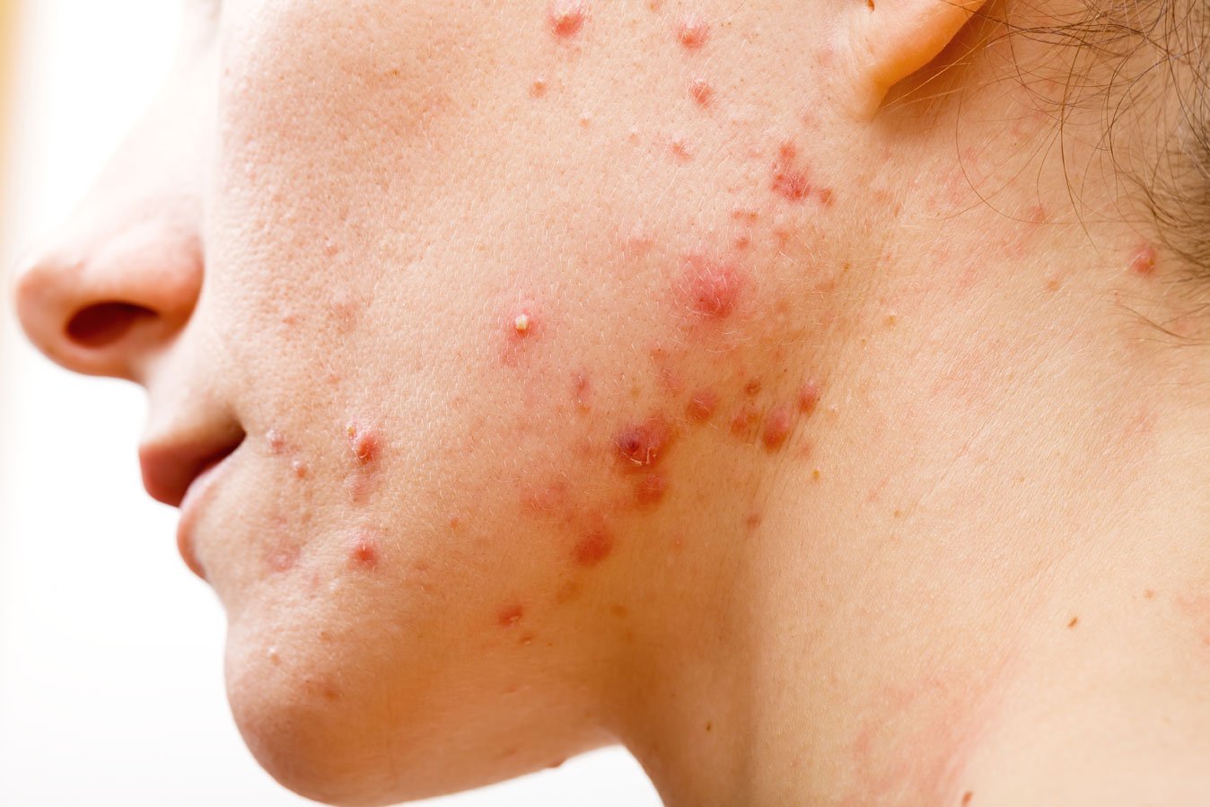 Cách phục hồi da bị bào mòn do corticoid & kem trộn