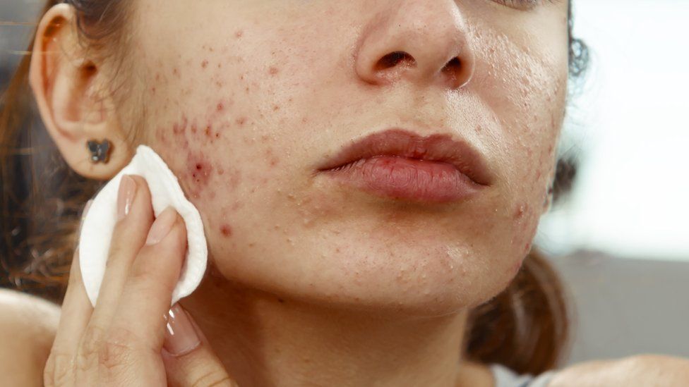 Nếu bạn bị mụn hoài không hết, hãy xem mình có mắc phải những lỗi này không nhé!