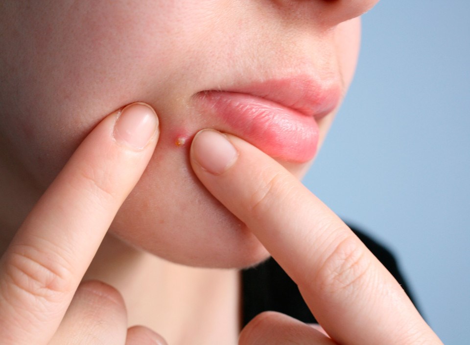 Có nên nặn mụn? Nếu không nặn mụn có tự hết không?