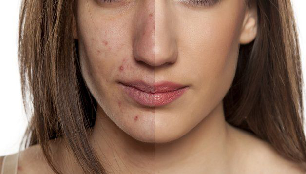 Xóa mờ vết thâm mụn một cách an toàn, hiệu quả và khoa học
