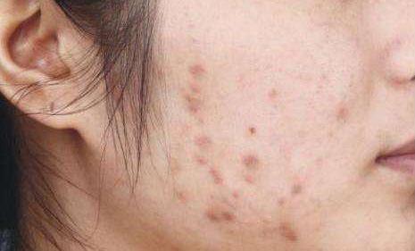 CÁCH TRỊ THÂM MỤN HIỆU QUẢ - AN TOÀN CHO MỌI LOẠI DA