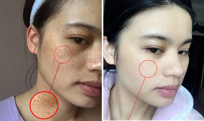 NGỠ NGÀNG VỚI “BÍ QUYẾT CHÂN TRUYỀN” HIỆU QUẢ XÓA NÁM LÊN ĐẾN 95 ‰