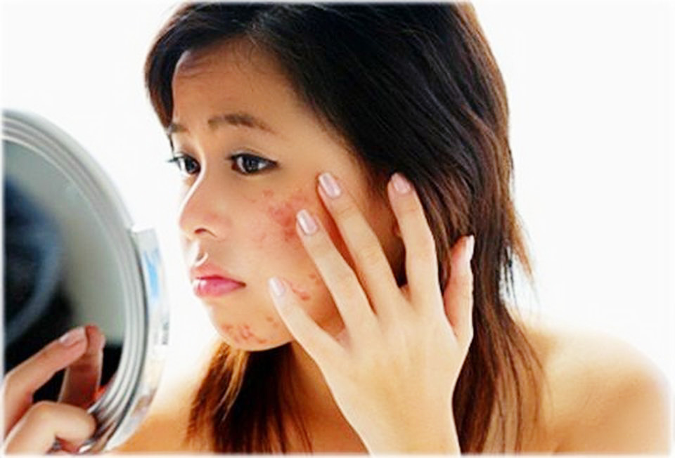 QUY TRÌNH CHĂM SÓC DA SAU KHI NẶN MỤN AN TOÀN KHÔNG ĐỂ LẠI VẾT THÂM SẸO