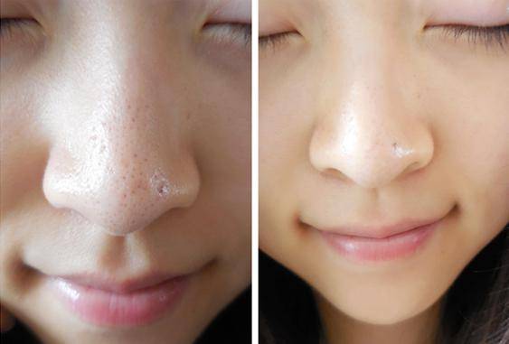 9 Bước trị mụn đầu đen - Hết Mụn Nhanh, Không Tái Mụn‎