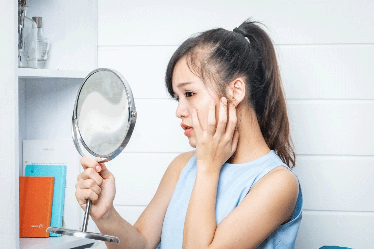 Giảm mụn tức thì – Lo ngại chi Tết