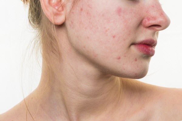 5 MÓN MỸ PHẨM BÌNH DÂN NÊN CÓ NẾU KHÔNG MUỐN BỊ MỤN THỜI TIẾT NÓNG ẨM NÀY