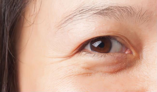 10 NĂM NHÌN LẠI KHI KHÔNG DÙNG KEM DƯỠNG MẮT