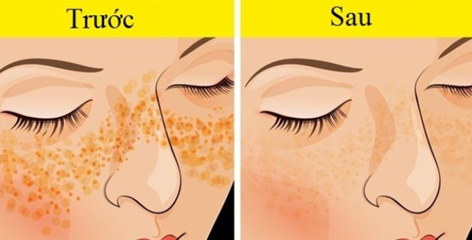 MẸO HAY CHIA TAY BỚT MỤN, NÁM DA VÀ VẾT THÂM