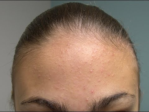 ĐIỀU TRỊ MỤN ẨN: NGỪA THÂM SAU KHI LẤY NHÂN MỤN
