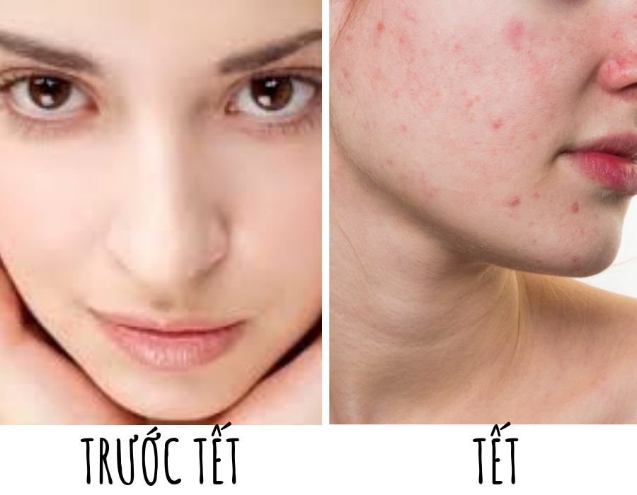 4 THÓI QUEN PHẢI TRÁNH XA NẾU KHÔNG MUỐN ĂN TẾT CÙNG MỤN