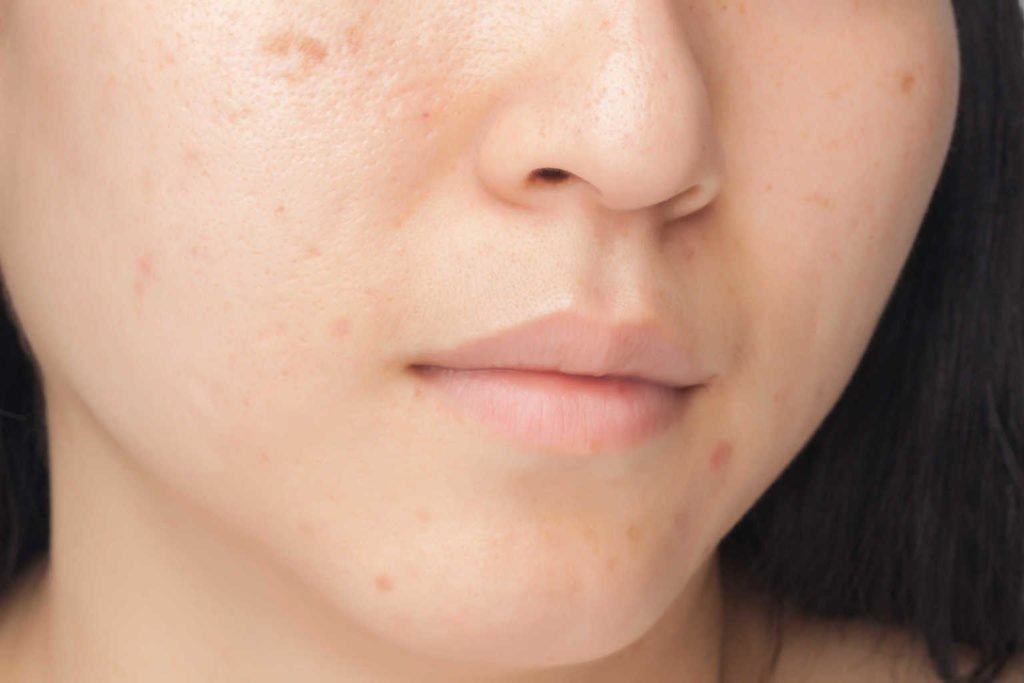 Sẹo mụn của bạn thuộc loại nào?