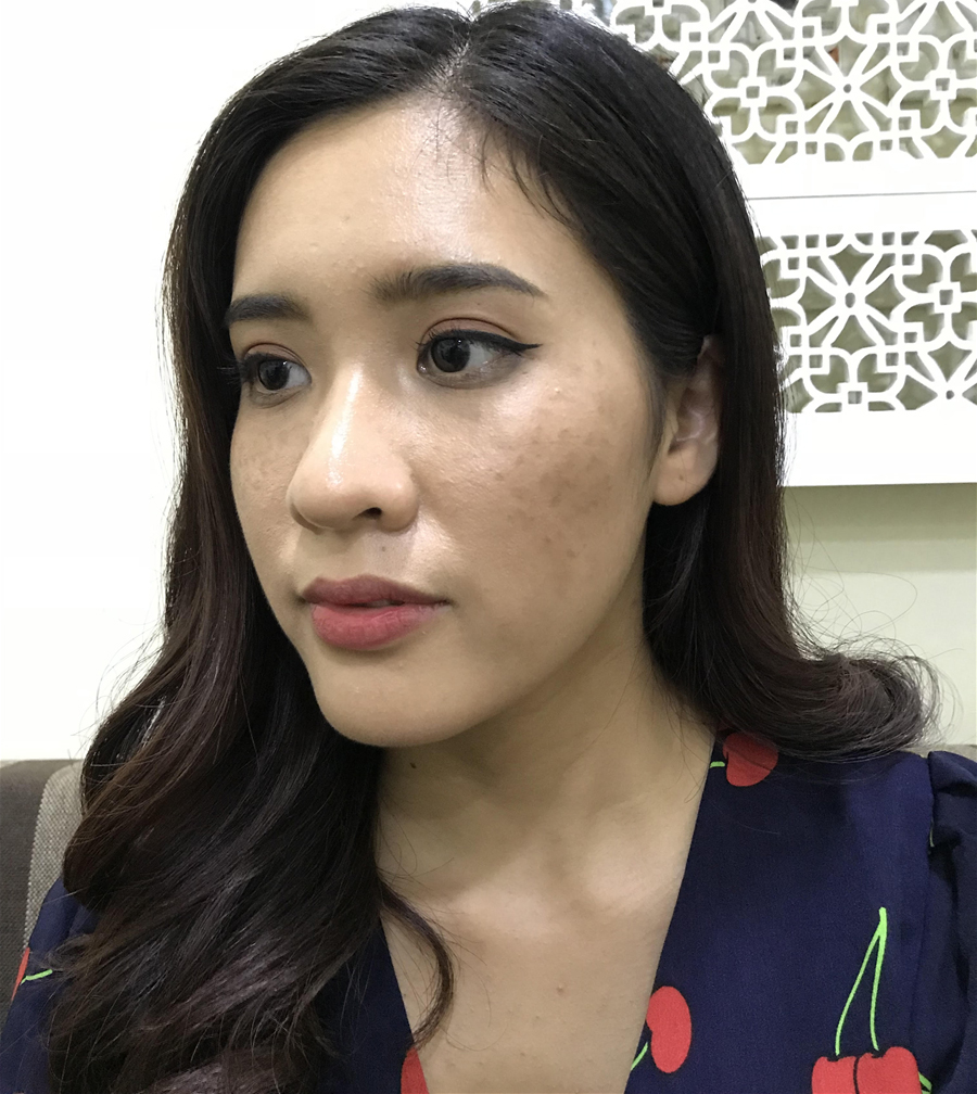 Tàn nhang và những điều chị em cần phải biết