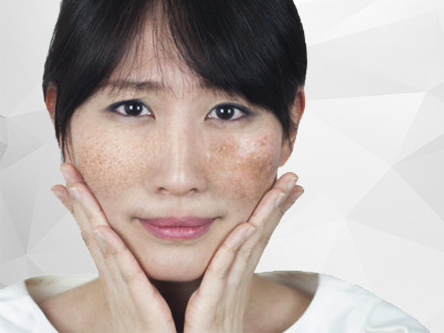 Hiểu rõ về nguyên nhân gây nám da để tìm cách điều trị hiệu quả