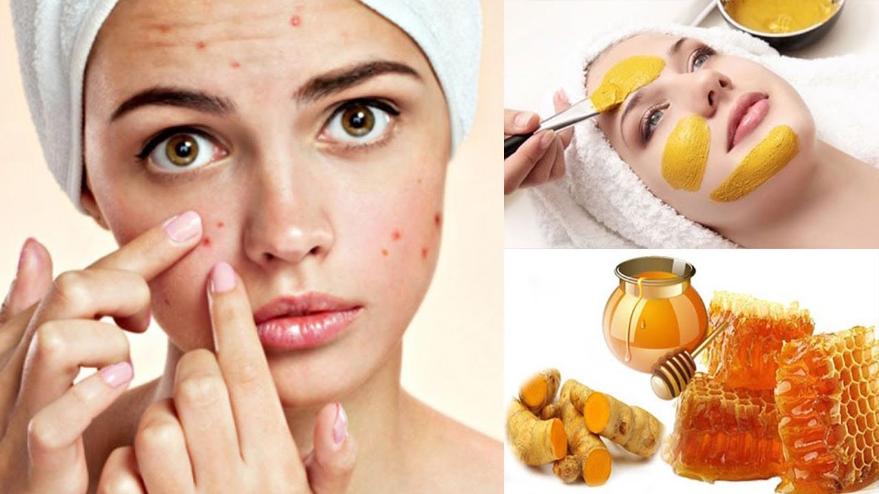 BẬT MÍ CÁCH TRỊ MỤN BẰNG MẬT ONG VỪA AN TOÀN VỪA HIỆU QUẢ