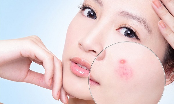 Cách trị mụn bọc sưng đỏ nhanh nhất