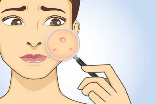 Tổng hợp cách chữa mụn mủ nhanh tại nhà hiệu quả