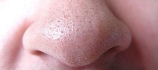 Mụn cám là gì? Nguyên nhân và cách điều trị mụn cám