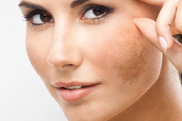 Cách trị nám da mặt bằng phương pháp thiên nhiên
