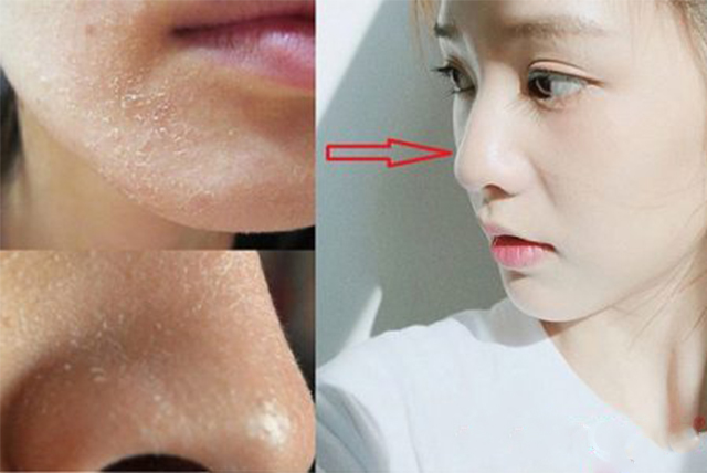 Kinh hãi vì làn da bong tróc, tôi đã tìm được cách khắc phục