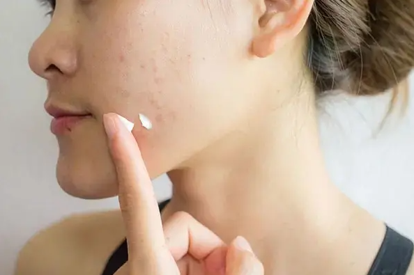 Trị mụn hiệu quả tại nhà chỉ với Benzoyl Peroxide