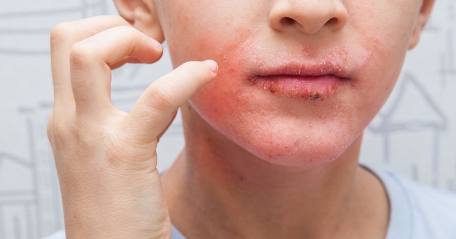 Làm Gì Khi Bị Dị Ứng Kem Chống Nắng: Nguyên Nhân Và Cách Khắc Phục