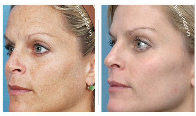 Hiệu quả của Serum giảm nám Image Skincare Total Bleaching Serum